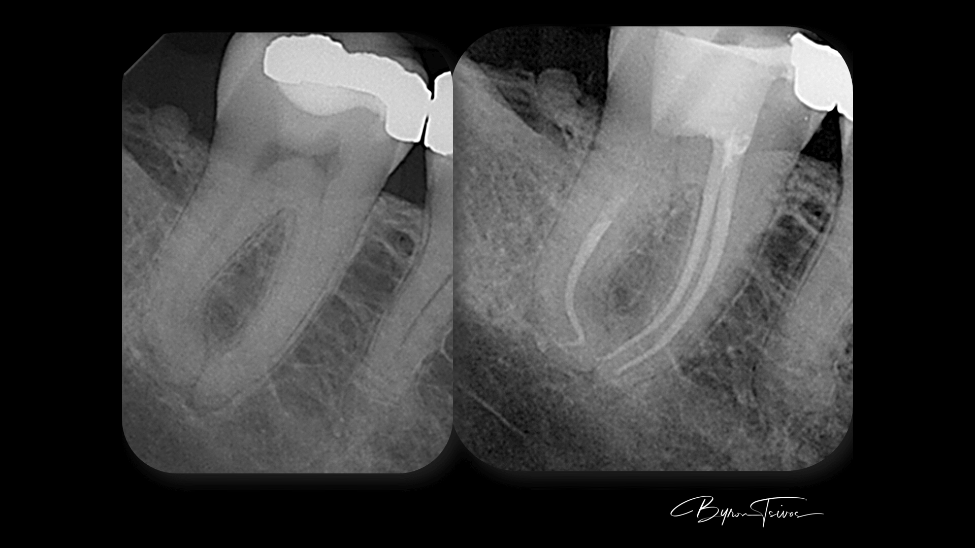 Curved Roots - Case 8